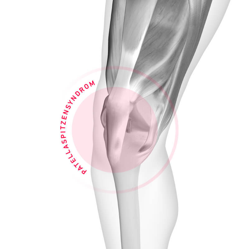 Patellaspitzensyndrom als Ursache für Knieschmerzen beim Laufen Schematische Darstellung Patellaspitzensyndrom